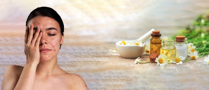How to Prevent and Remove Pimples and Acne Scars Naturally